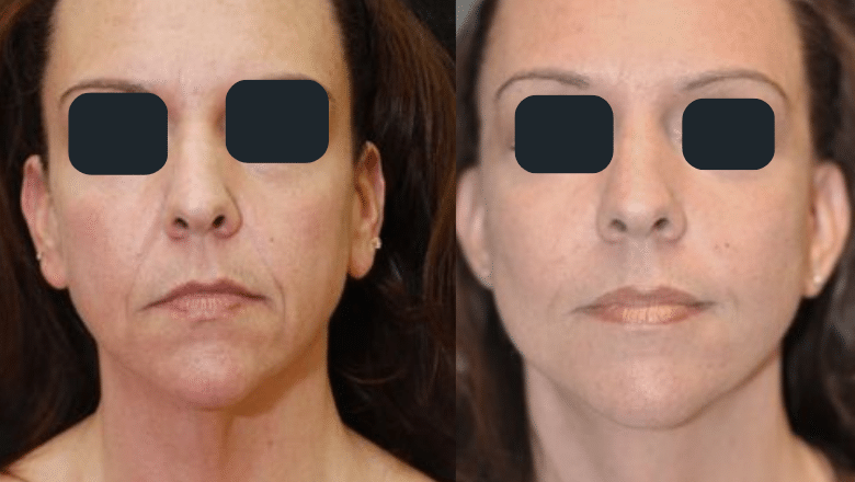 neck lift surgery before and after 1