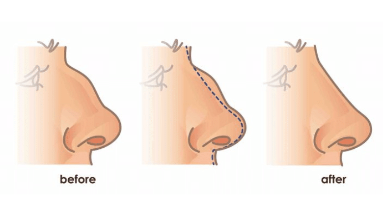 What are the different types of nose shapes, and what do they mean