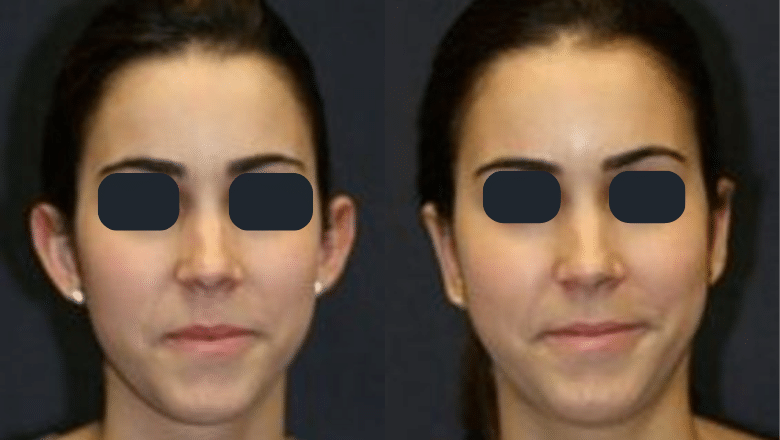 otoplasty before after 2