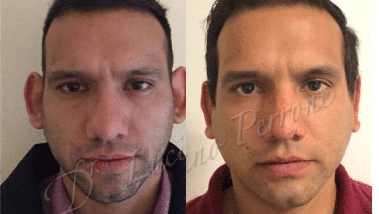 otoplasty before after 4