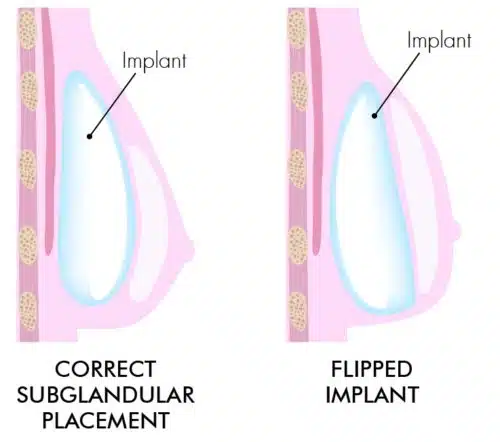 Breast Implant Flipping