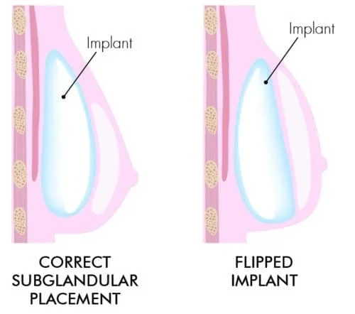 Breast Implant Flipping