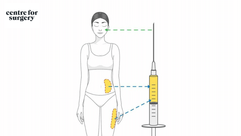 Facial fat transfer procedure