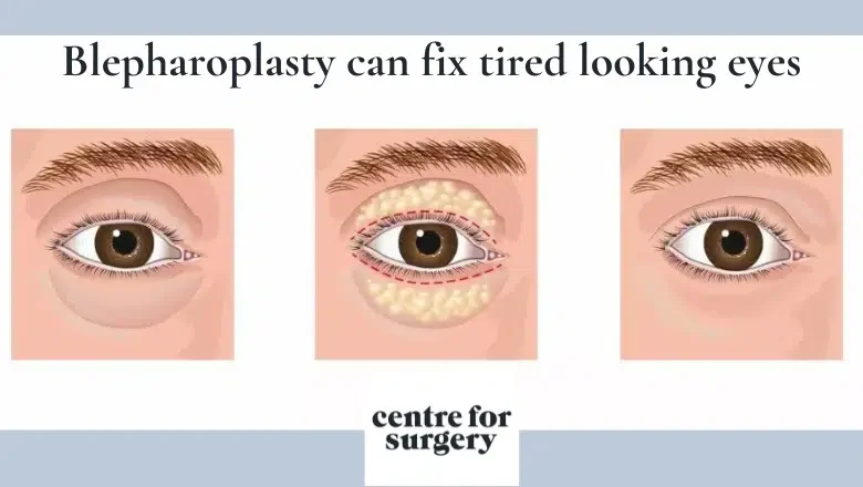 Tired-looking-eyes-surgical-options-1.png.webp?format=webp&nv=212368fc-2000-40d1-9026-c0f94abda644