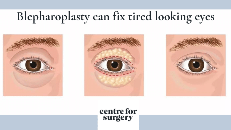 tired looking eyes surgical options blepharoplasty