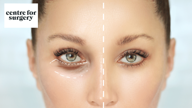 fix droopy eyelids with surgery