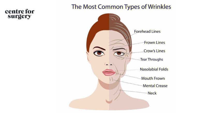 common types of wrinkles