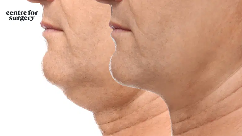 double chin removal London