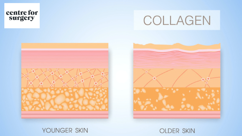 saggy jowls collagen