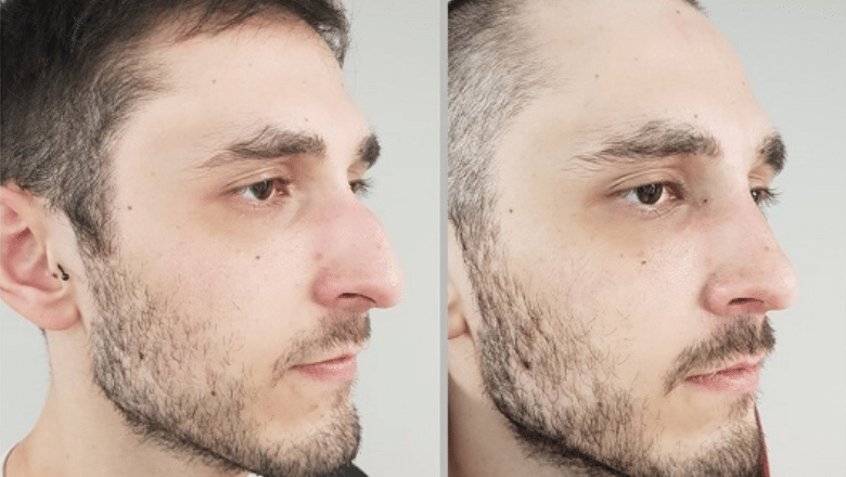 male rhinoplasty surgery before after 2