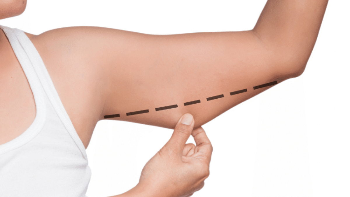 Non Surgical Arm Lifts, Armpit Fat, Fat Removal for Arms
