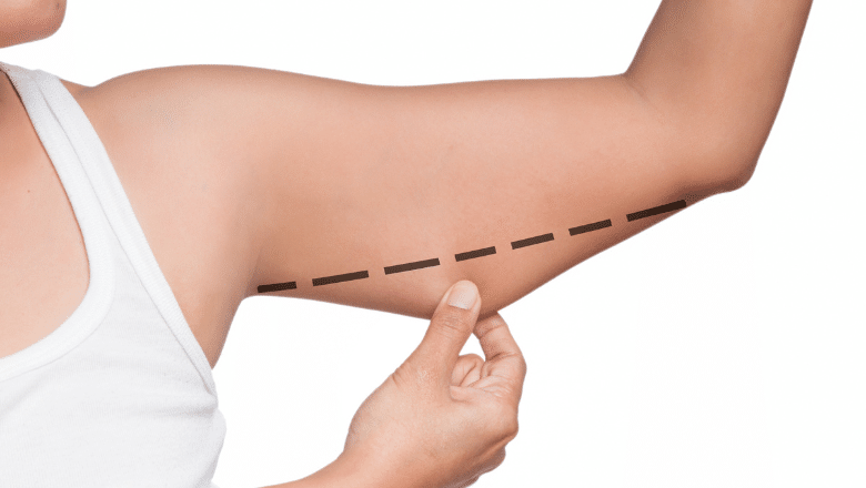 Arm Lift vs Arm Liposuction