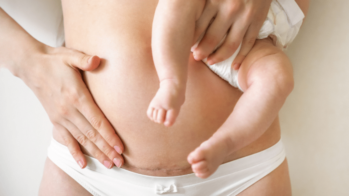 C Section Pouch - Causes, Treatment, and Prevention | Centre for Surgery