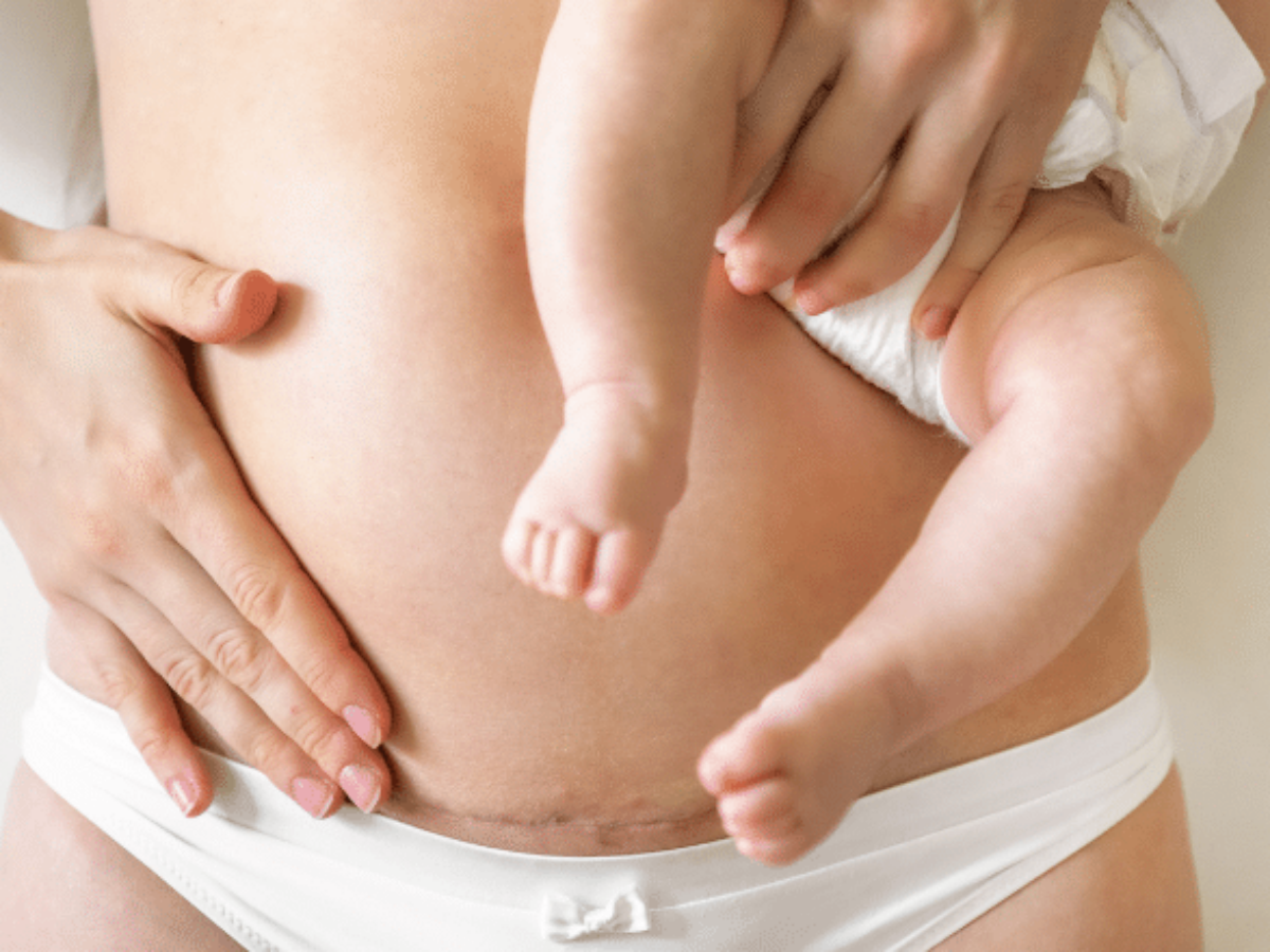 C Section Pouch - Causes, Treatment, and Prevention | Centre for Surgery