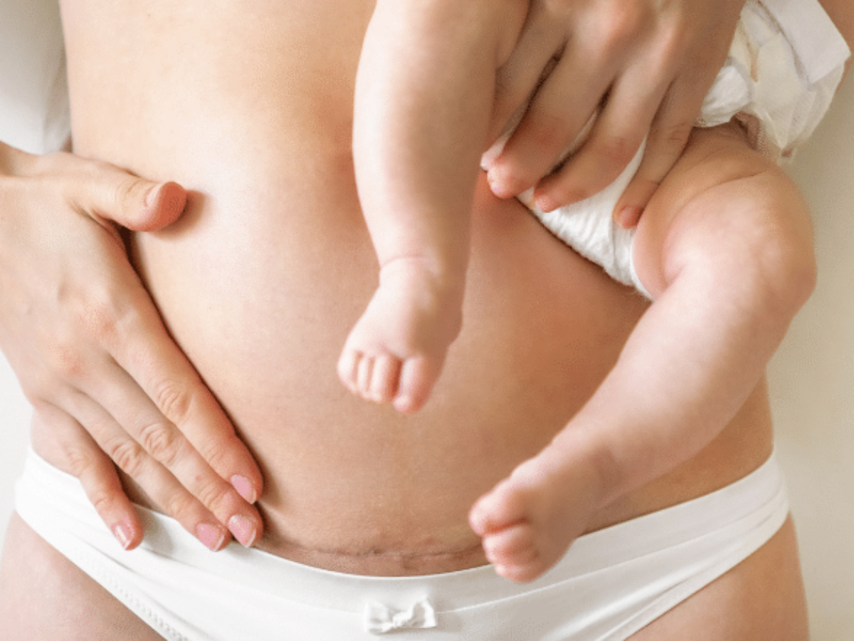5 Facts About Hanging Belly After Child birth - Cosmetic Surgeon