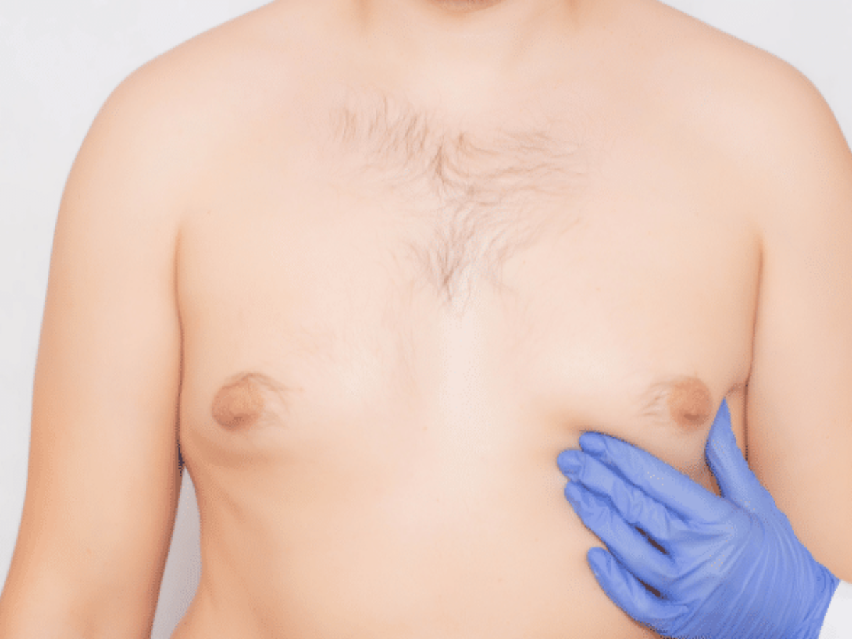 Belt Lipectomy with Bilateral Excision of Gynecomastia and Liposuction of  the chest