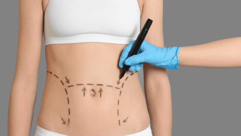Post Bariatric Body Contouring Procedures
