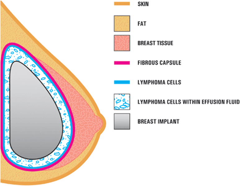 Symptoms-diagnosis-and-treatment-of-breast-implant-associated-cancer-BIA-ALCL-Illustration