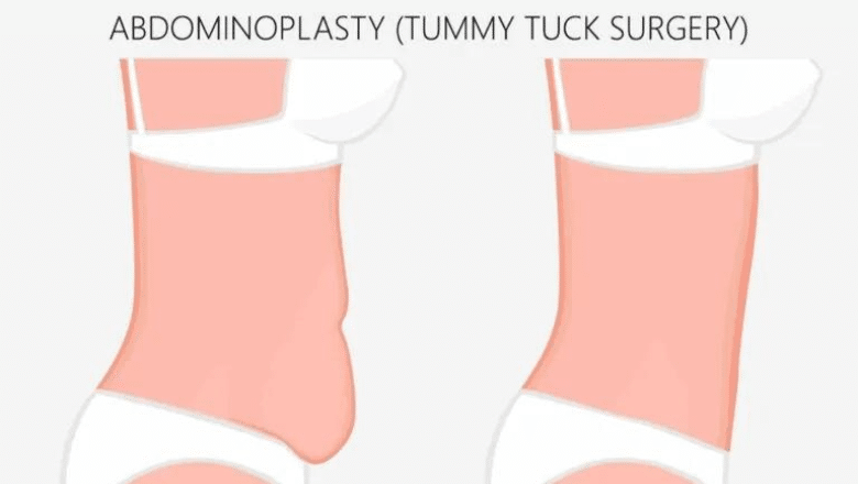 C Section Pouch - Causes, Treatment, and Prevention | Centre for Surgery