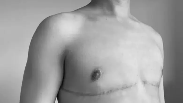 FTM Top Surgery Scars