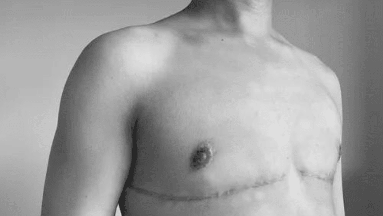 FTM Top Surgery Scars