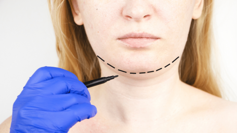 Botched Chin Liposuction Procedure
