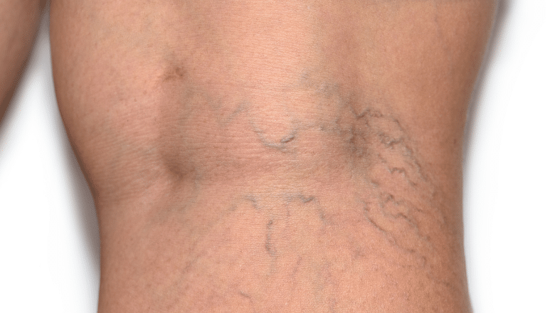 Can Sclerotherapy Get Rid of Spider Veins