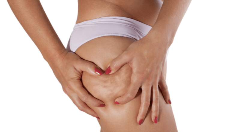 Cellulite Treatment Options London UK