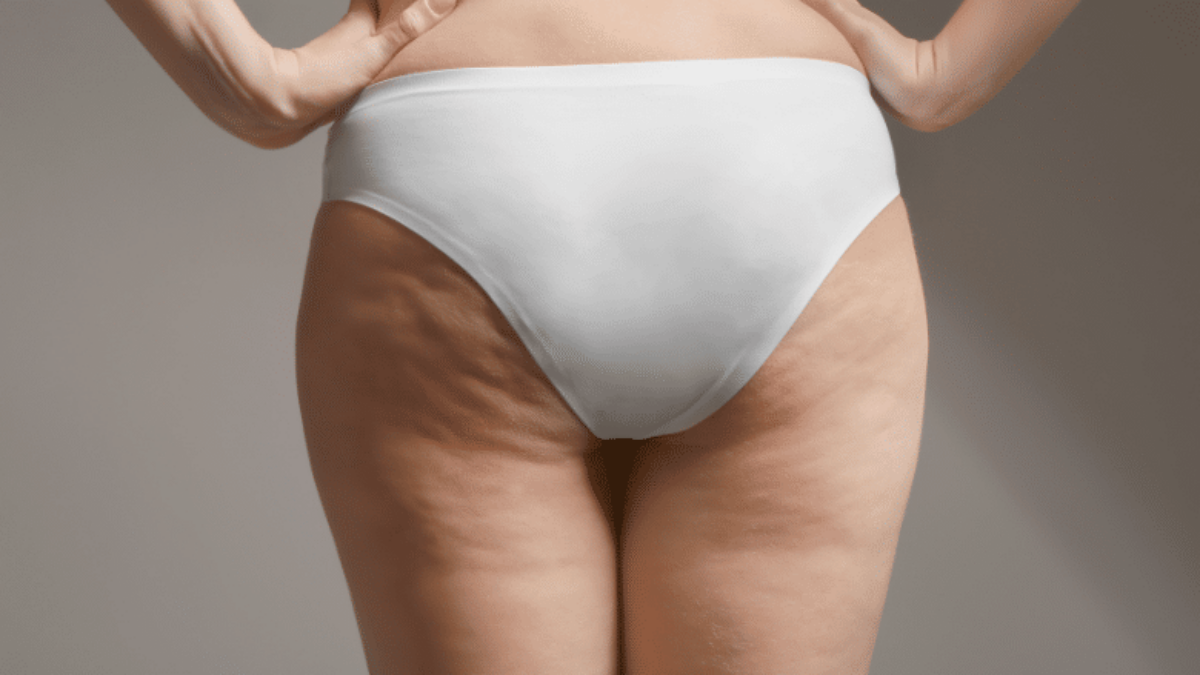 Bothered By Cellulite? 4 Cellulite Reduction Treatments That Work Wonders