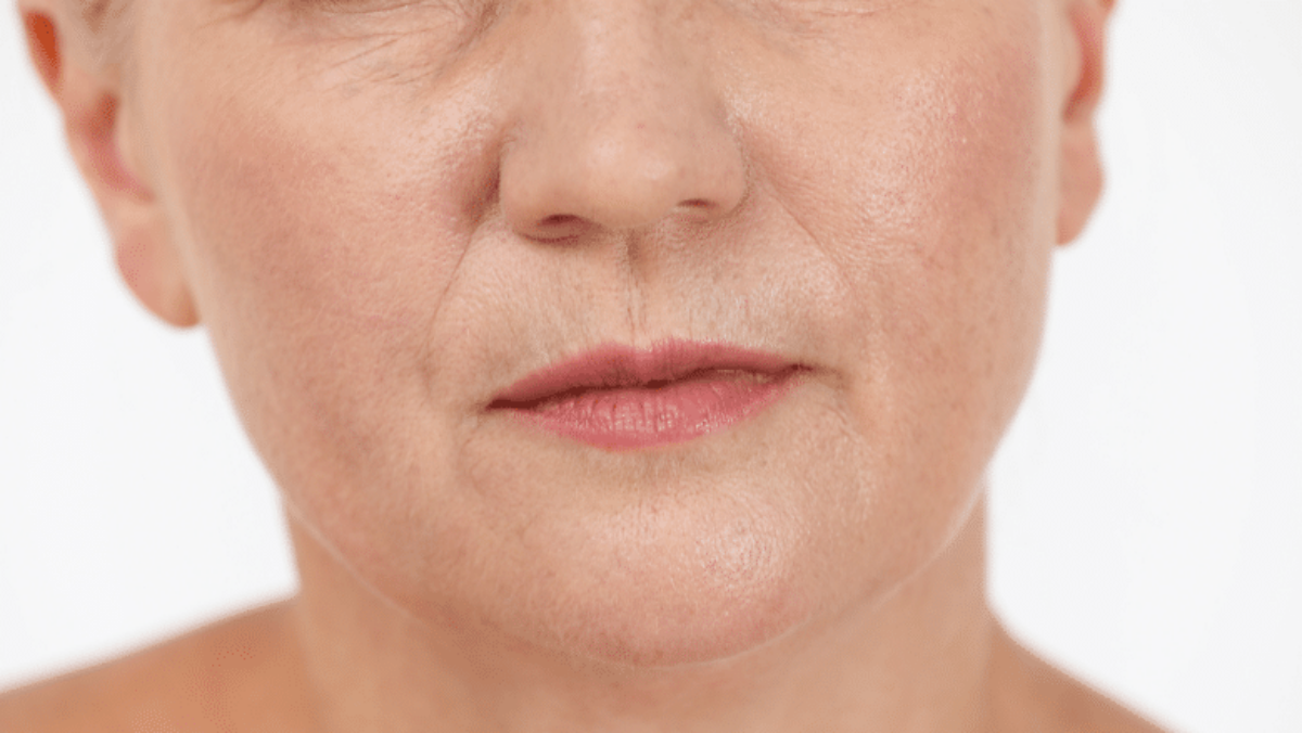 Smokers Lines How to Get Rid of Upper Lip Lines Wrinkles