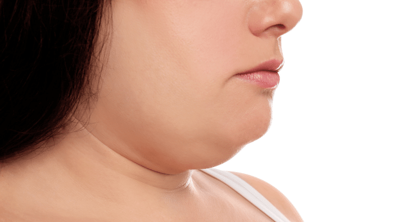 Cost Of Liposuction For Double Chin