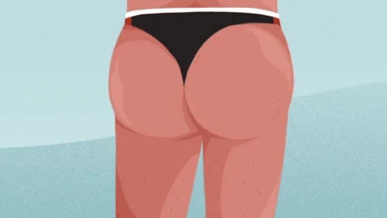 BBL shapes & types demystified: Discover your dream butt shape