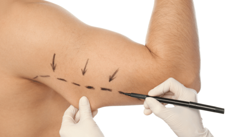 Arm Lift Scars - How to Reduce Scarring after Brachioplasty 