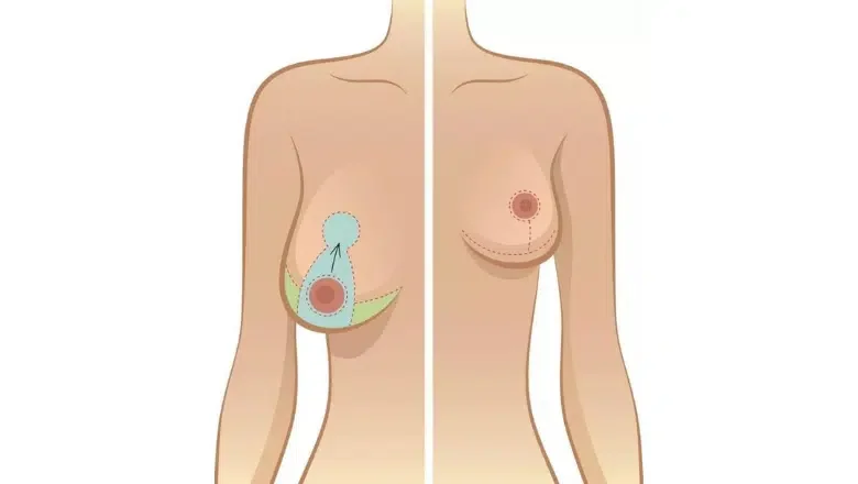 Breast Reduction Scars