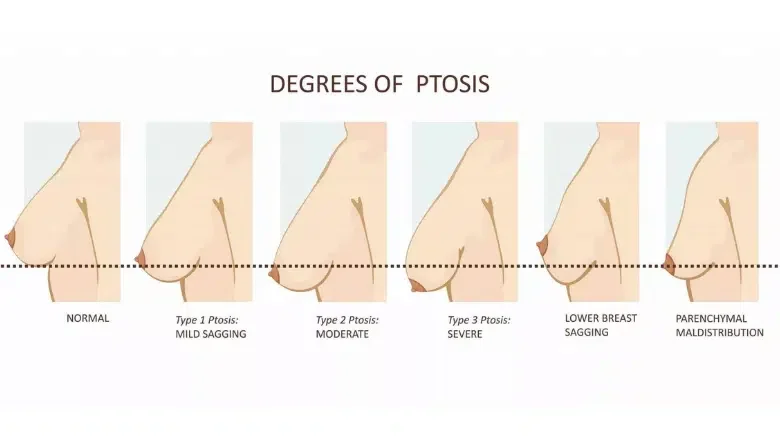 Classification of Saggy Breasts