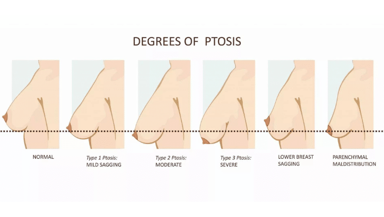 Classification of Saggy Breasts