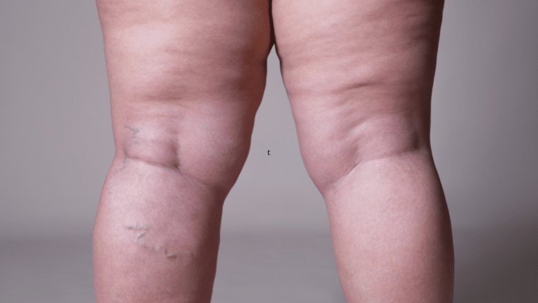 How to Get Rid of Lipoedema Fat