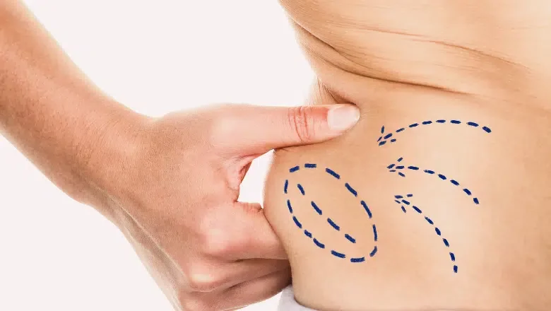 Liposuction common areas