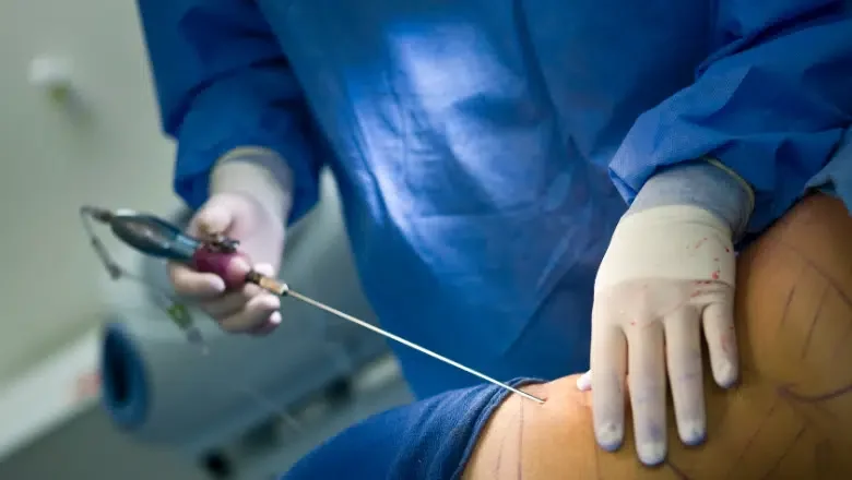 Liposuction procedure