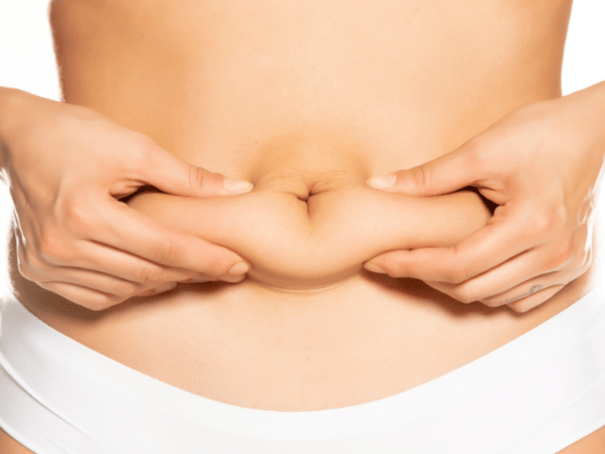 Liposuction vs Tummy Tuck For a Flatter Stomach