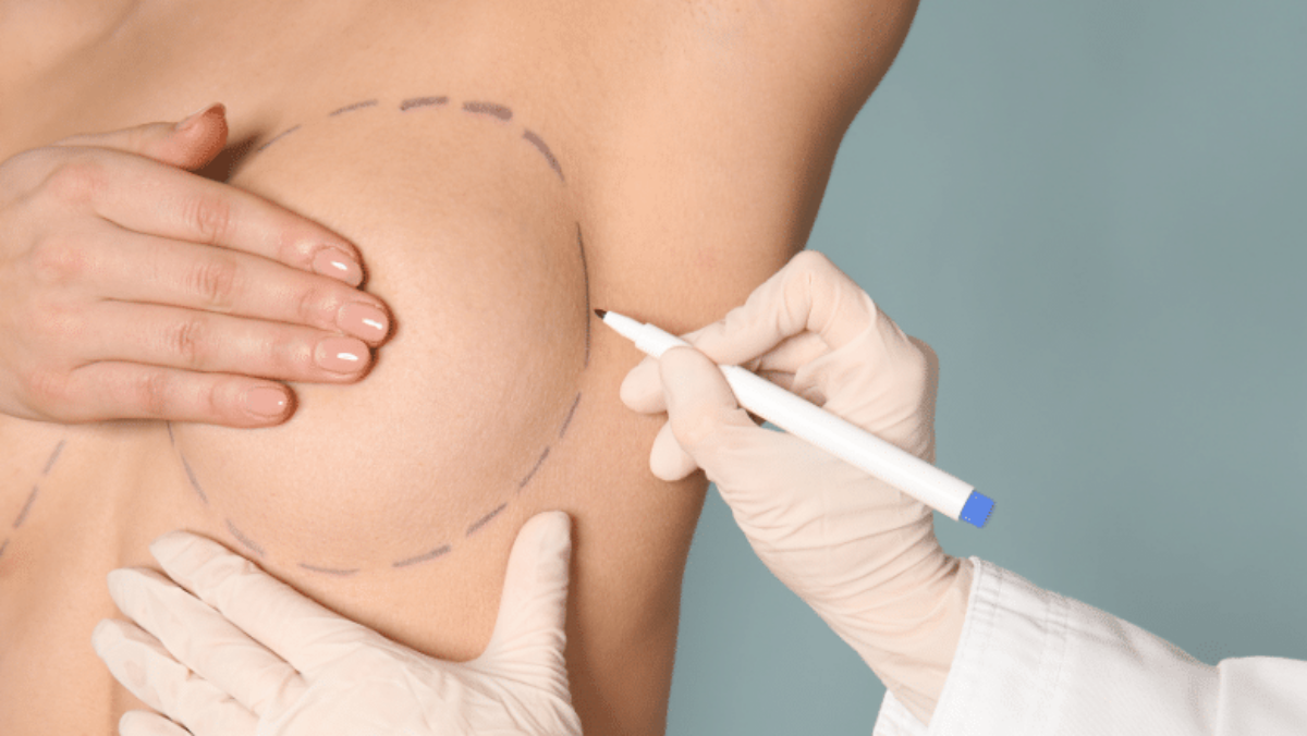 Reducing Scars After Breast Surgery - Top Tips