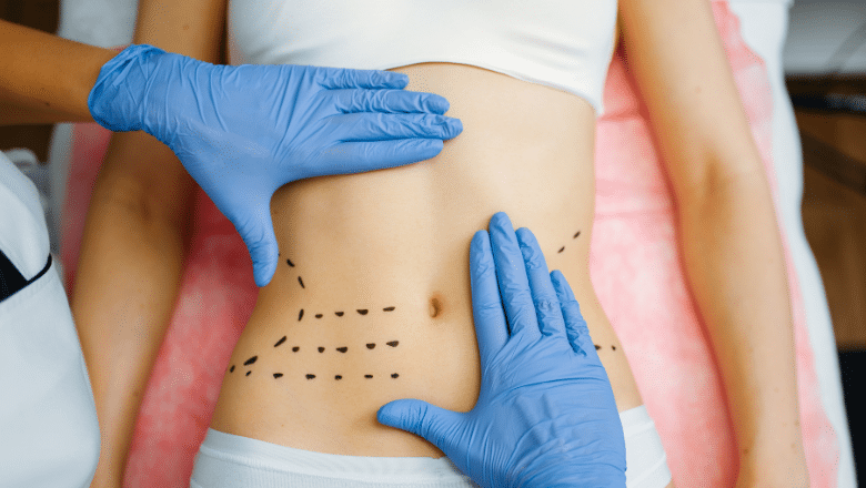Muscle Repair During Tummy Tuck - Dr. Hess