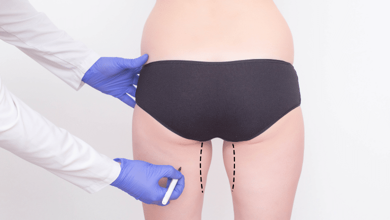 Thigh Lift Scars - How to Reduce Scarring after Thighplasty