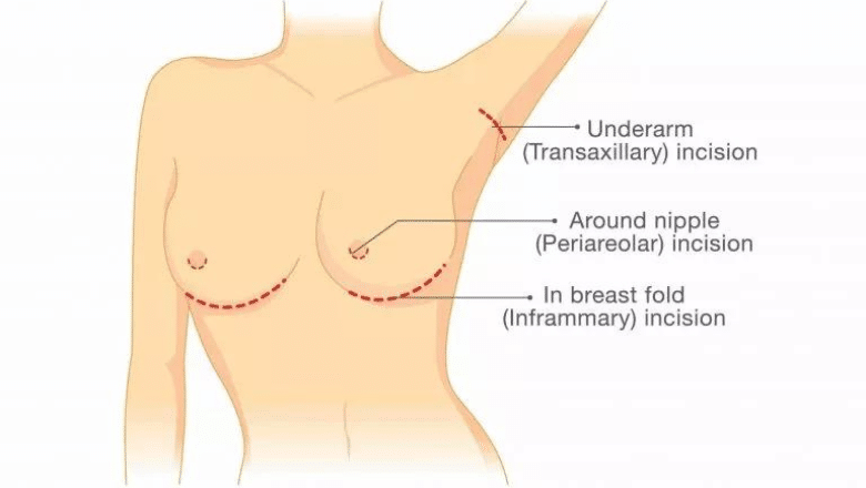 breast augmentation scars