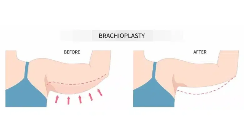 arm-lift-surgery.png.webp?format=webp&nv=ca64acd6-a6db-44c0-8ef1-3388dfd37a49