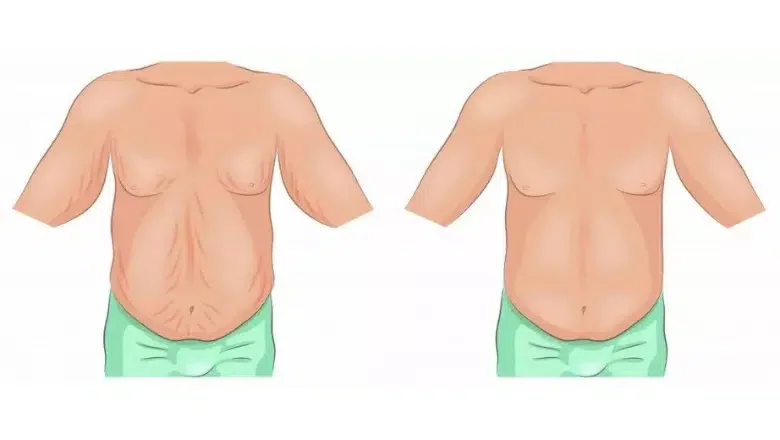 belt lipectomy excess skin removal