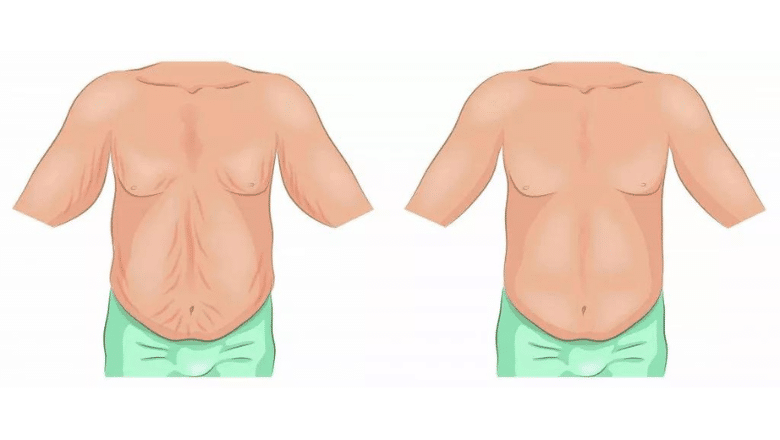 belt lipectomy excess skin removal