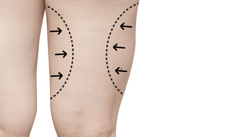 liposuction for lipoedema