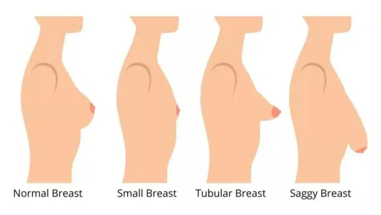 tubular breasts diagram