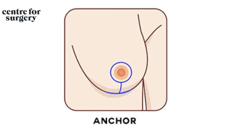 anchor incision breast lift